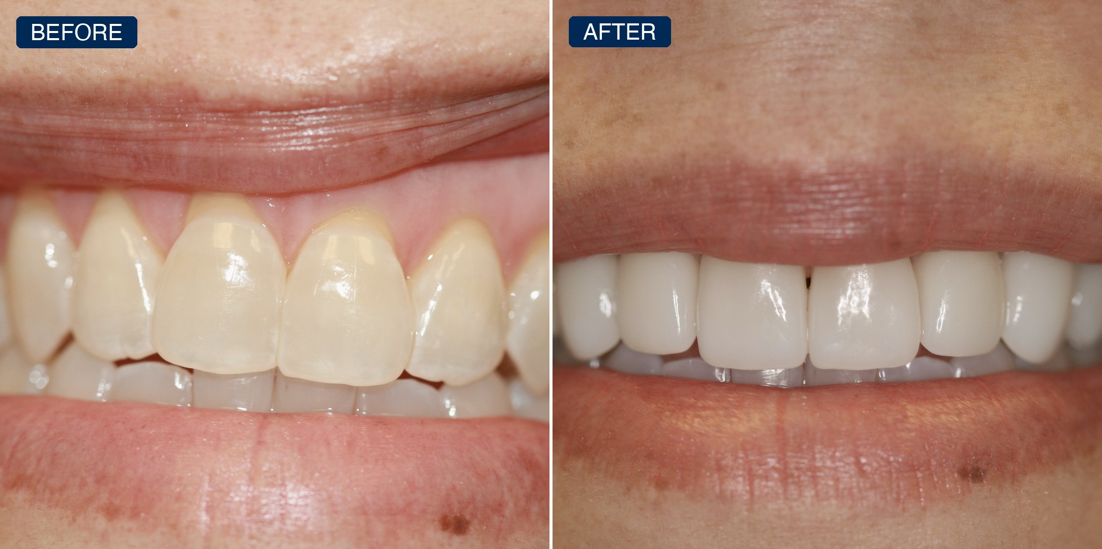 Before and after: yellowed, worn front teeth restored to an even, bright smile