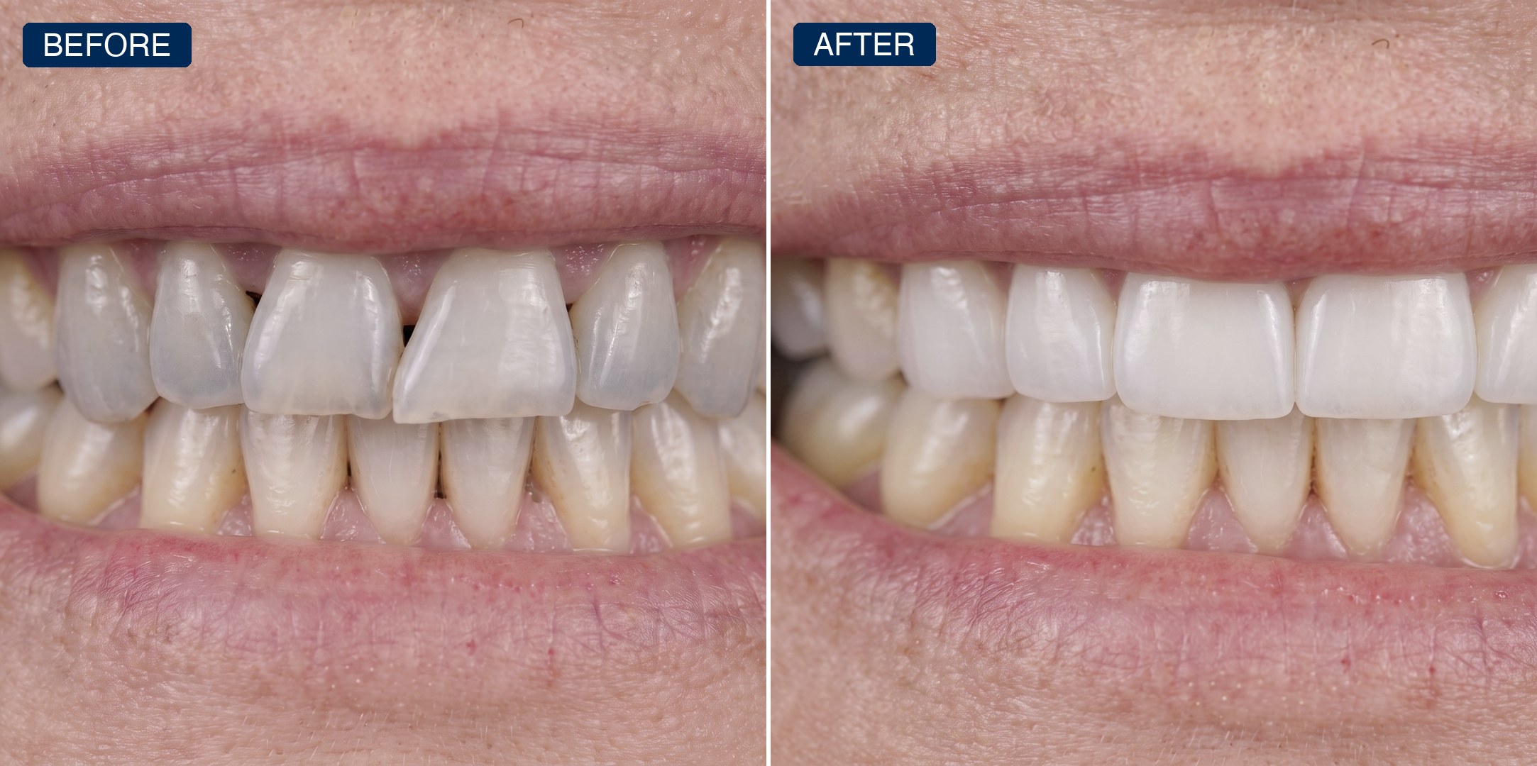 Before and after: dull, grayish, overlapping front teeth restored to an even, bright smile
