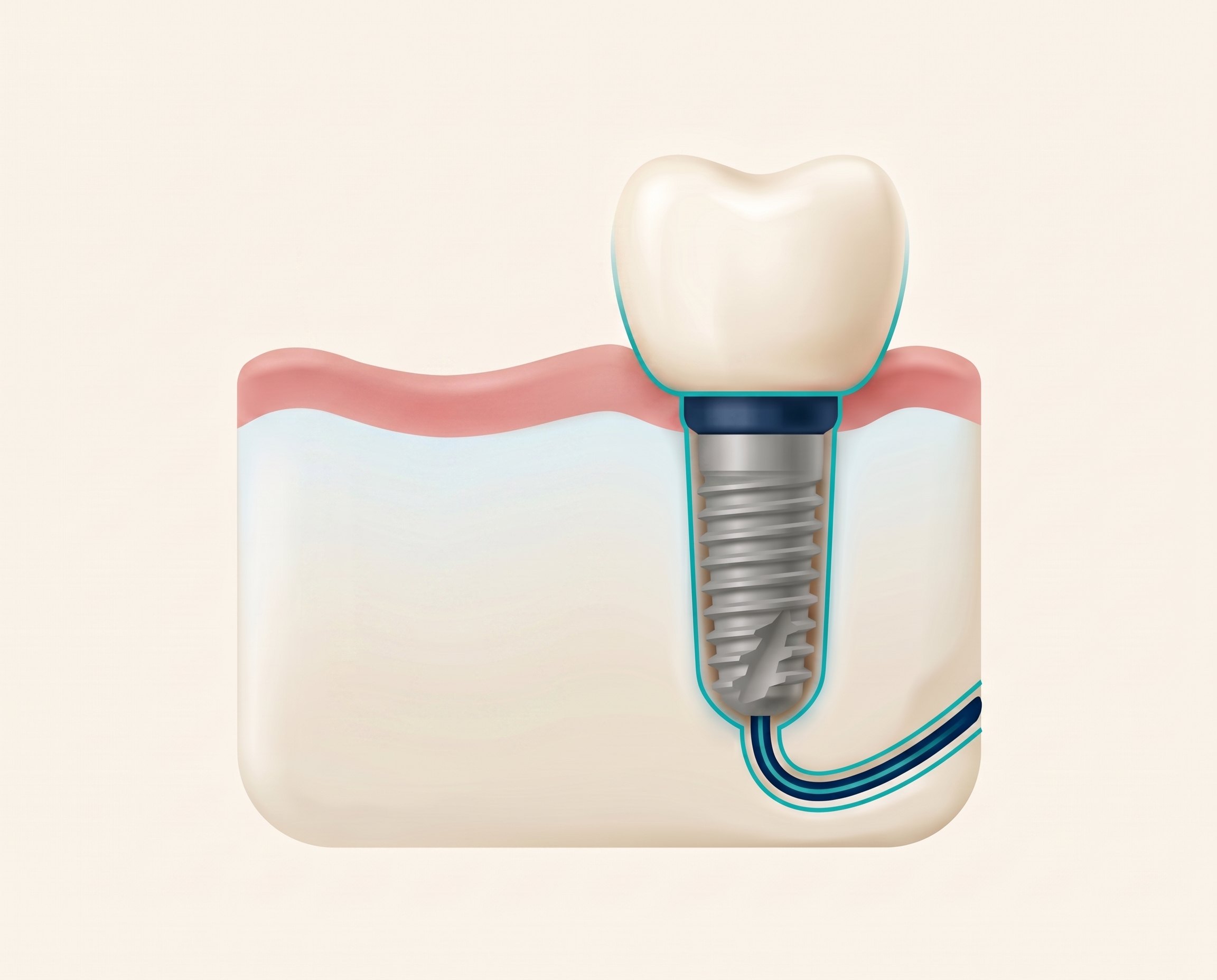 Illustration of a single implant in the jawbone with a crown