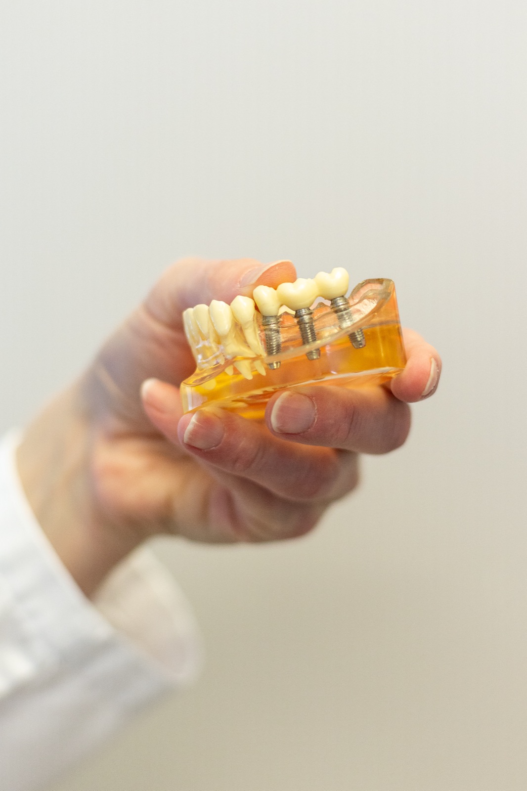 A dental implant model showing how implants support replacement teeth
