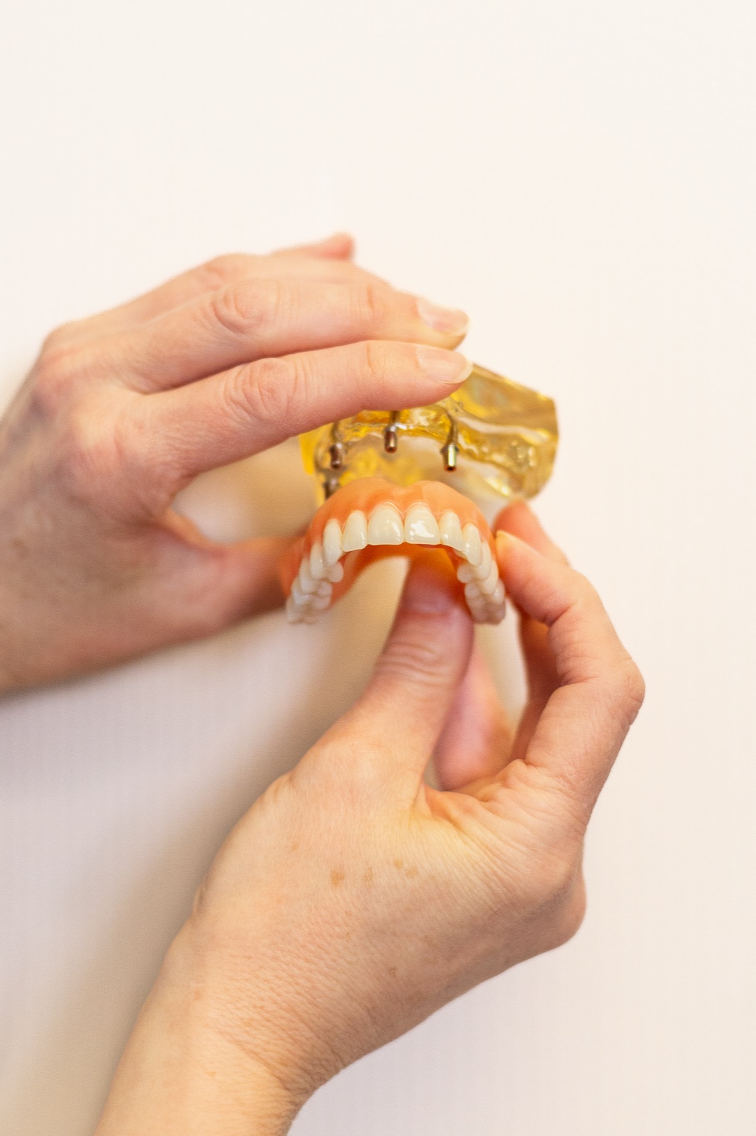 A finished custom implant-supported denture